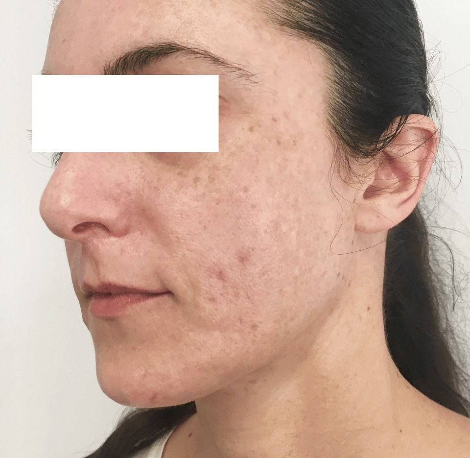 After — facial acne
