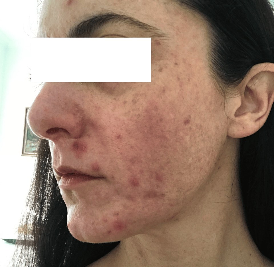 Before — facial acne
