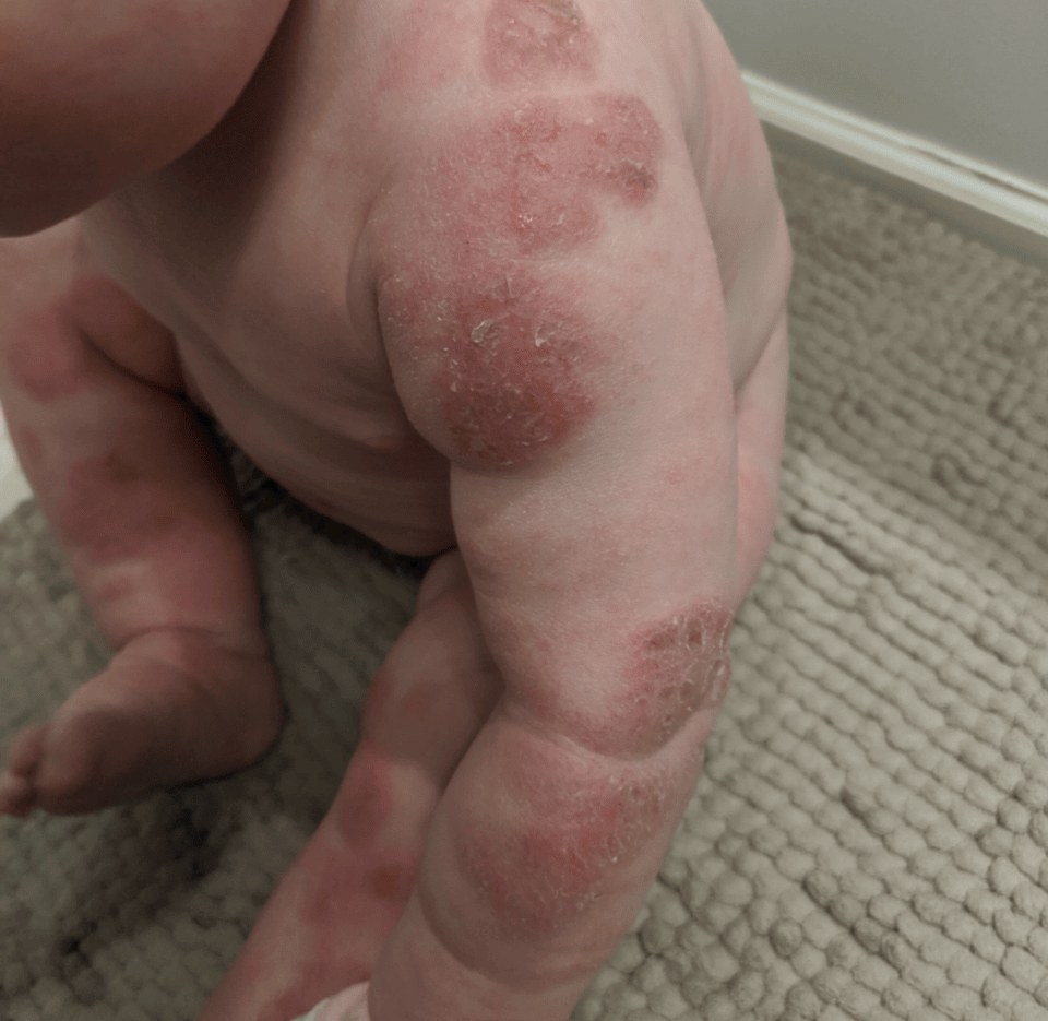 Before — infant body eczema