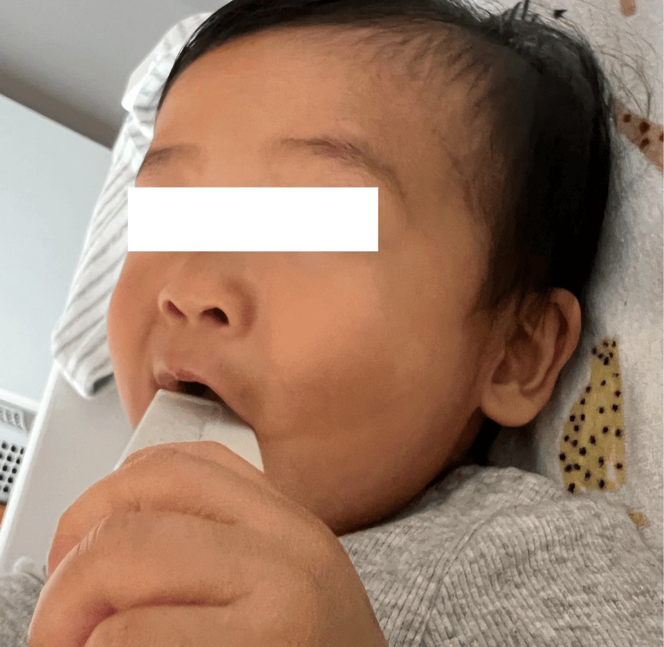 After — baby facial eczema