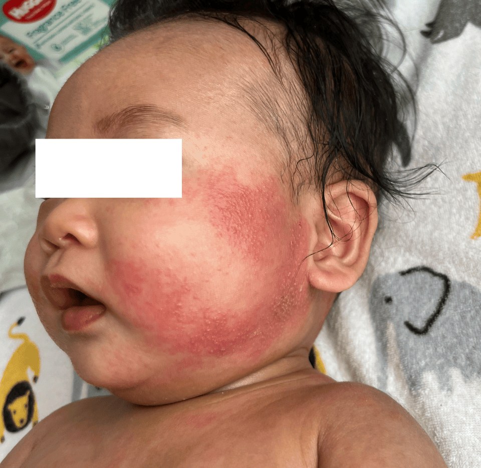 Before — baby facial eczema