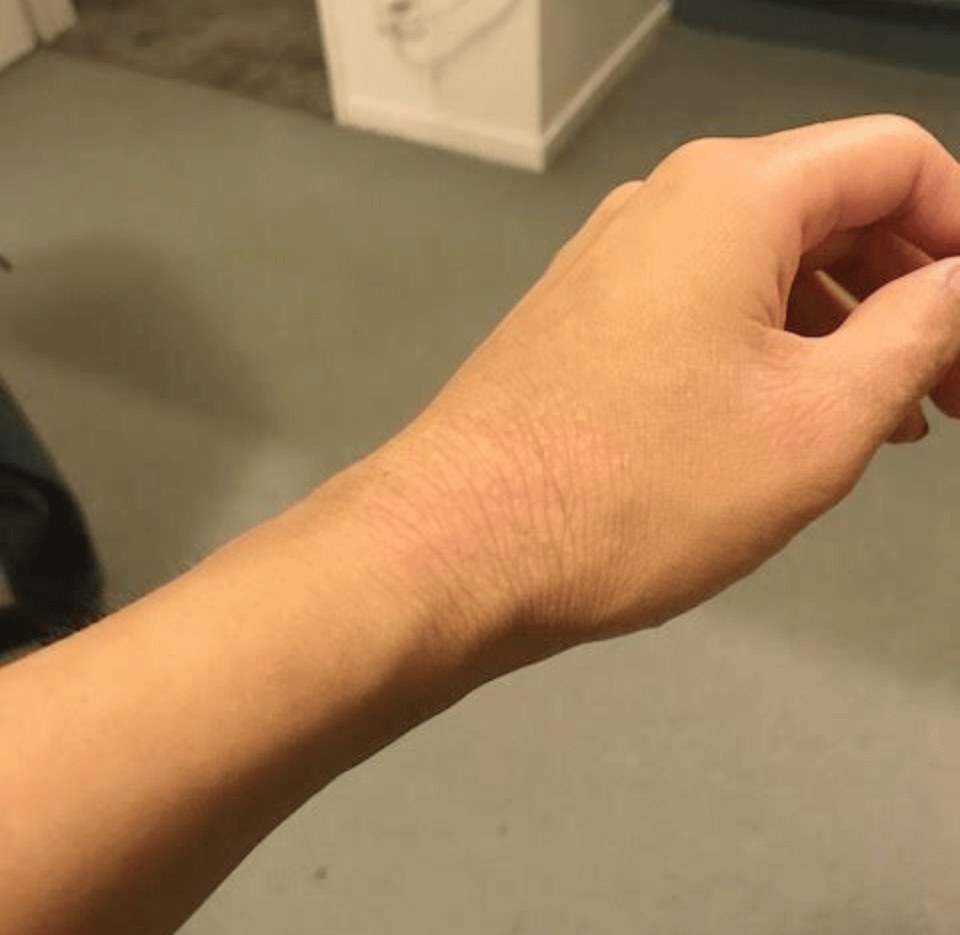 After — hand eczema