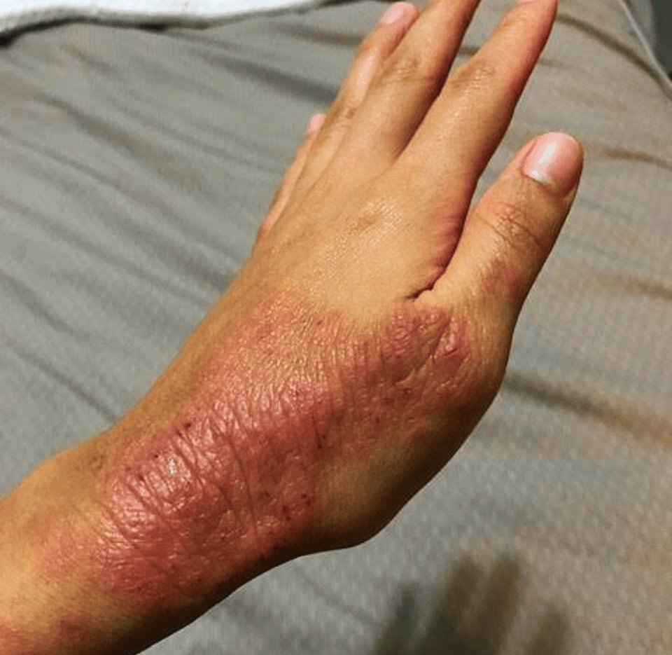 Before — hand eczema