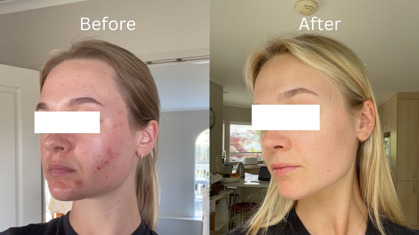 A Waterwell patient’s acne before treatment, and after.