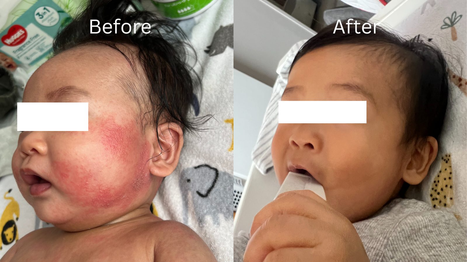 A Waterwell patient’s eczema before treatment, and after.
