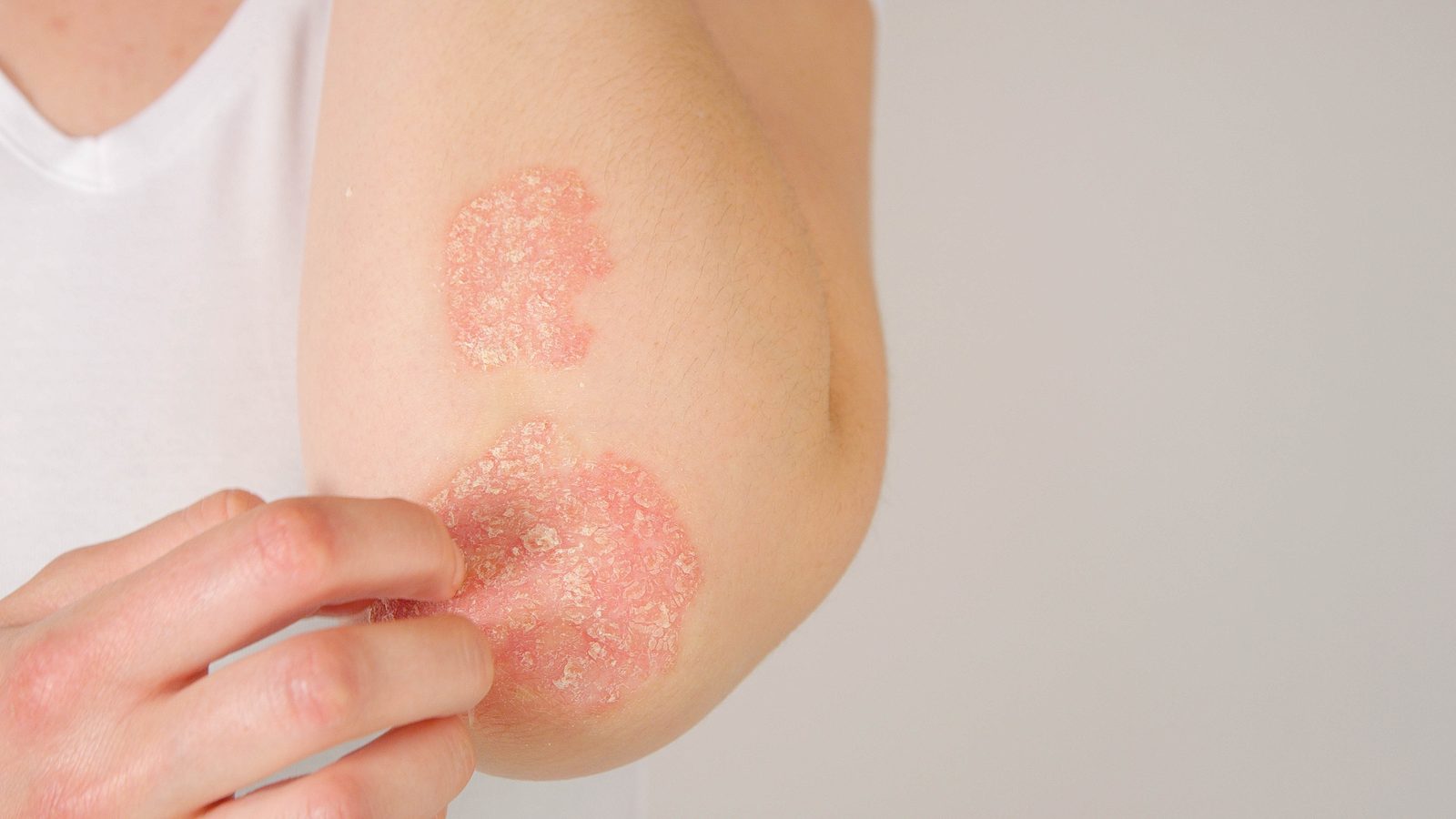 Plaque psoriasis at the elbow — one of the presentations Kohei works with.