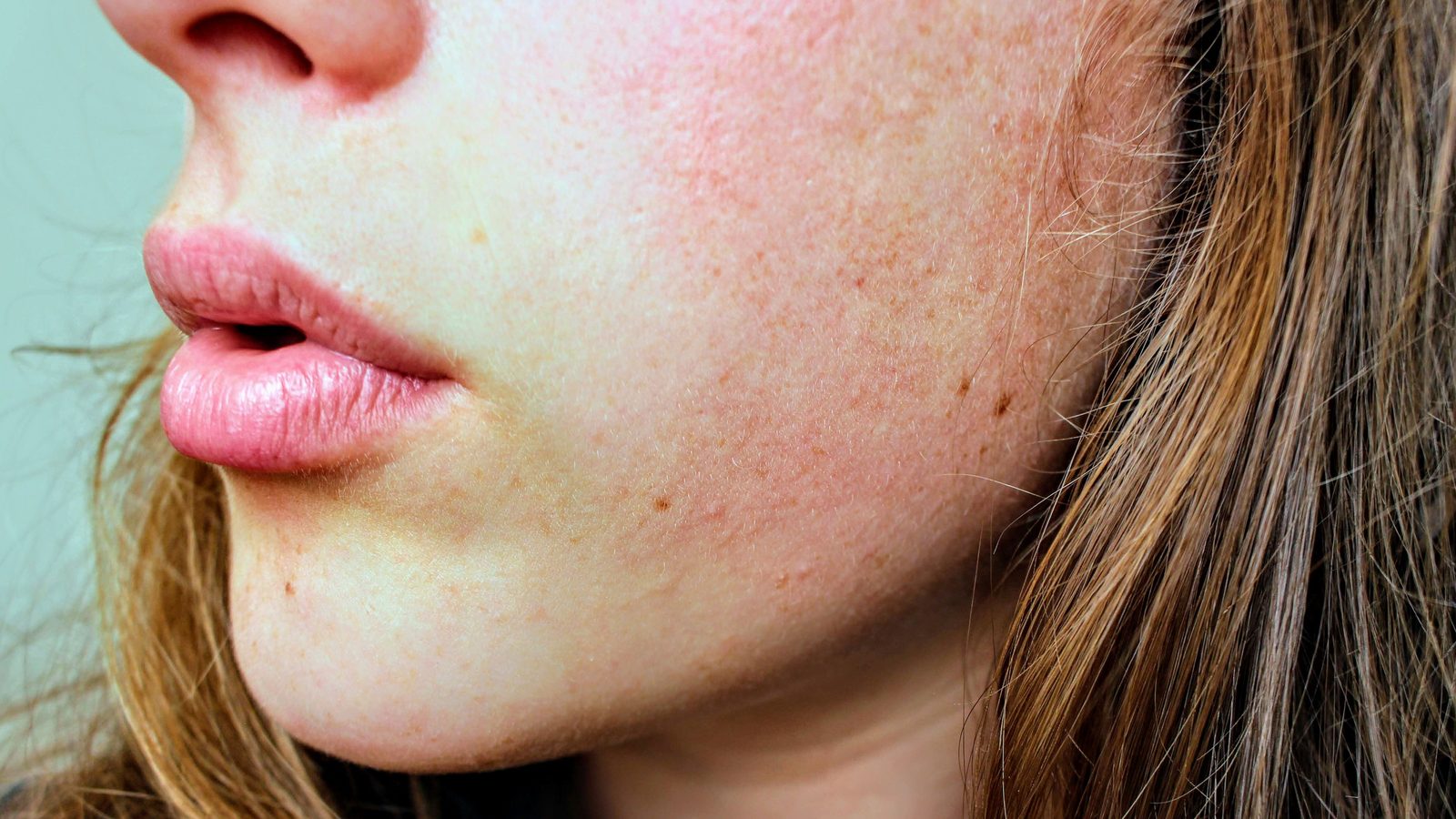 Rosacea across the cheek and jaw — one of the presentations Kohei works with.
