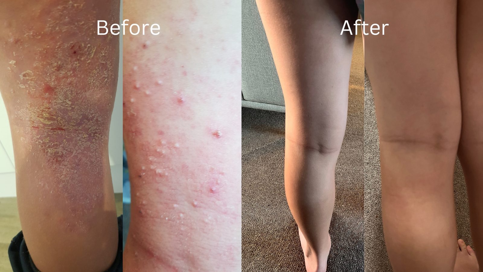 A Waterwell patient’s skin infection before treatment, and after.