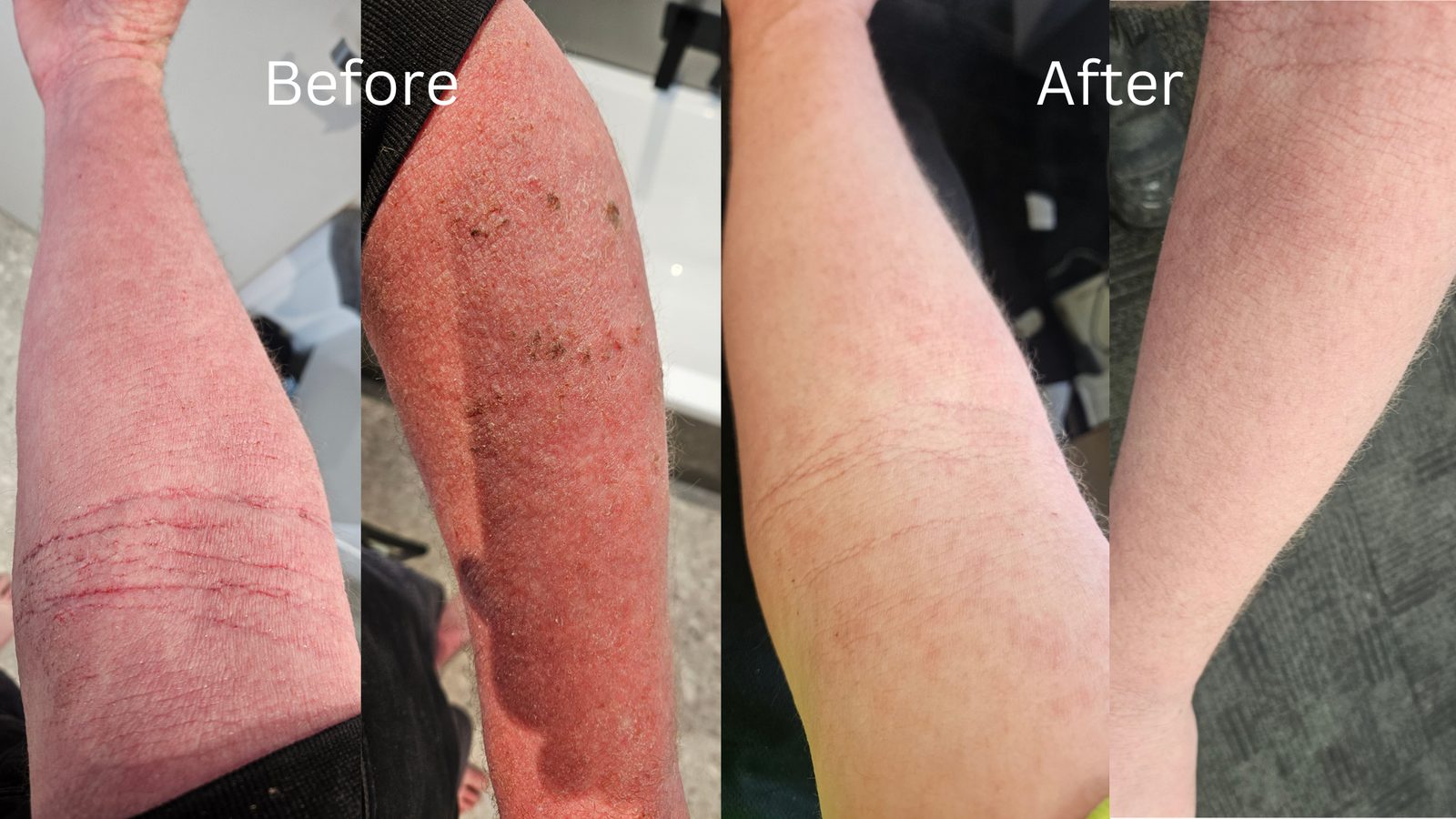 A Waterwell patient going through topical steroid withdrawal, before and after.