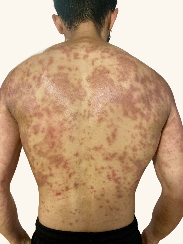 Kohei Iguchi's back covered in widespread inflamed eczema