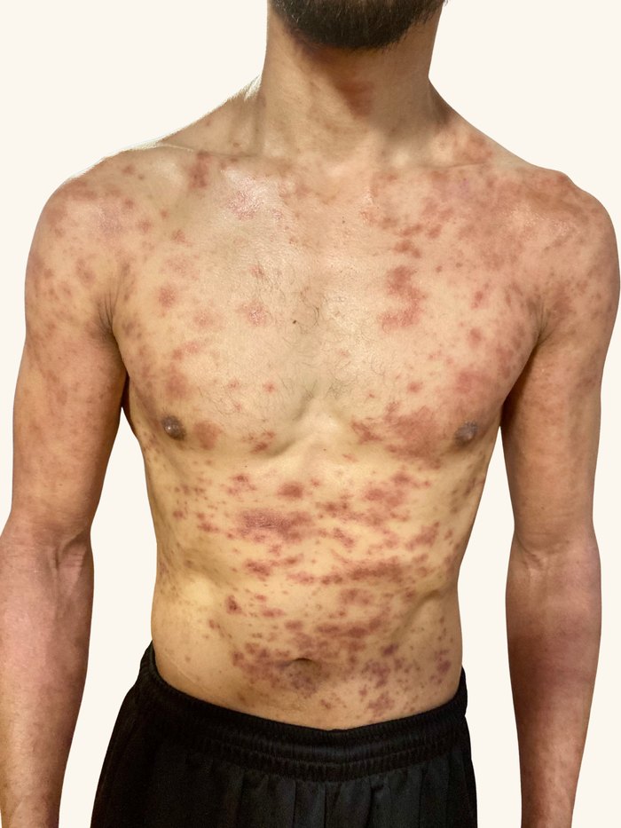 Kohei Iguchi's chest and torso covered in widespread inflamed eczema